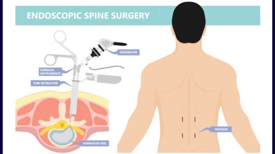 Ενδοσκοπική χειρουργική σπονδυλικής στήλης
